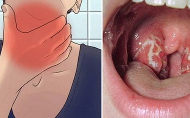 Bạch hầu ở trẻ em là bệnh nhiễm trùng do vi khuẩn bạch hầu gây ra, biểu hiện phần lớn ở hầu họng