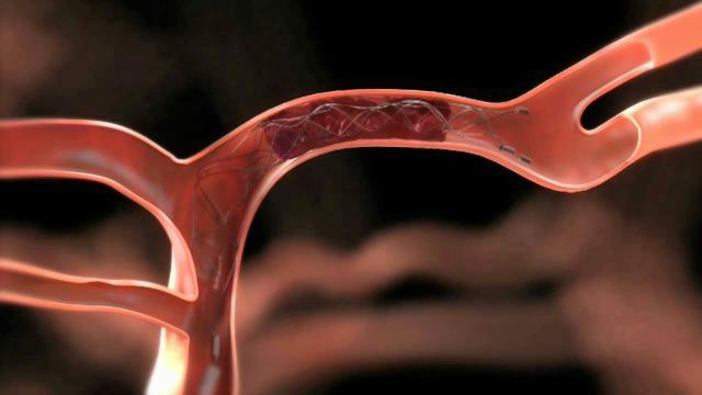 Điều trị đột quỵ nhồi máu não được thực hiện như thế nào? 4