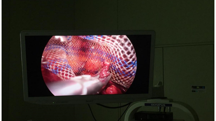 Điều trị thoát vị bẹn bằng lưới nhân tạo bằng phương pháp nội soi 3