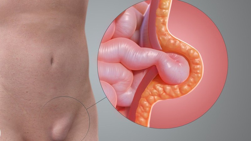 Điều trị thoát vị bẹn bằng phẫu thuật robot là thế nào? 1