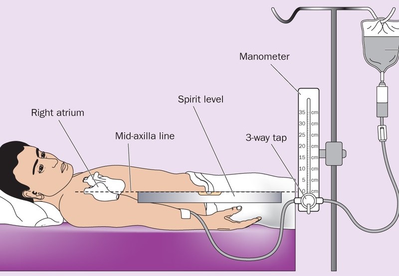 Đo CVP là gì? Quy trình thực hiện đo CVP không phải ai cũng biết 1