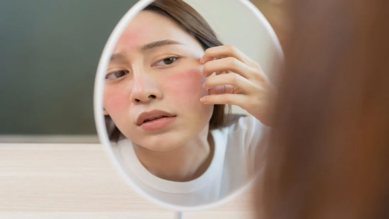 Đỏ mặt: Khái niệm, nguyên nhân và giải pháp can thiệp 3