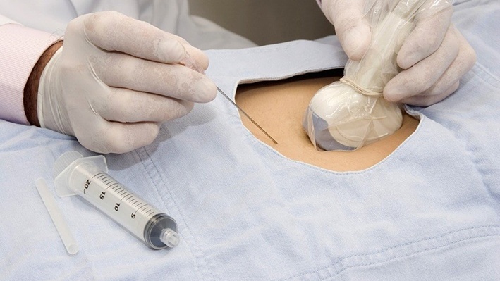 Độ mờ da gáy cao nhưng chọc ối bình thường 2