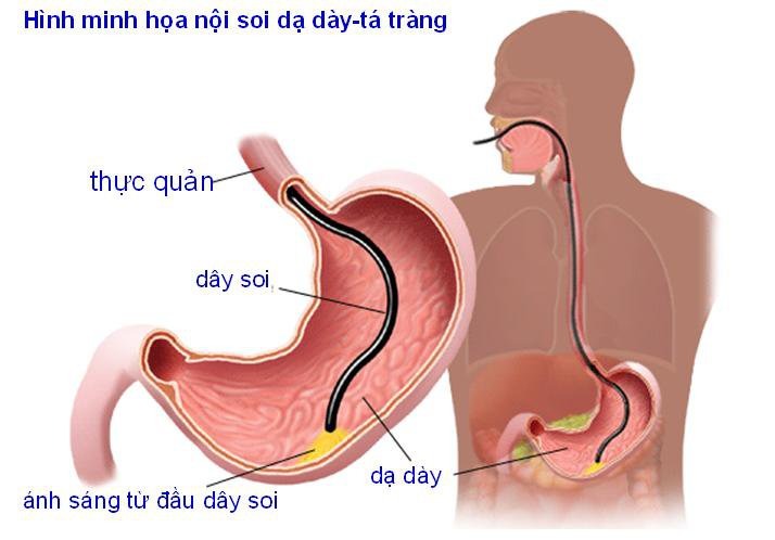 Đối tượng cần chỉ định thực hiện nội soi tiêu hóa 1