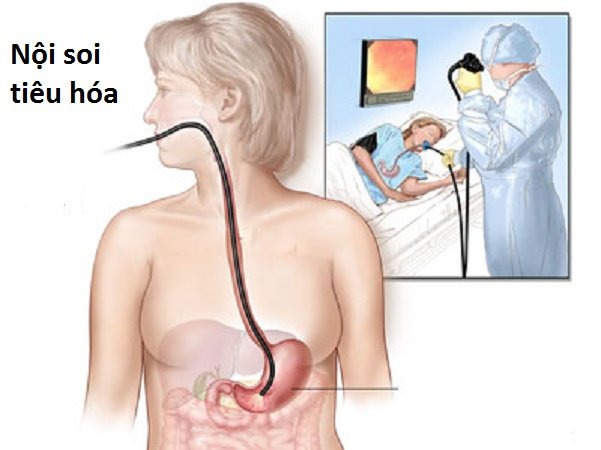 Đối tượng cần chỉ định thực hiện nội soi tiêu hóa 2