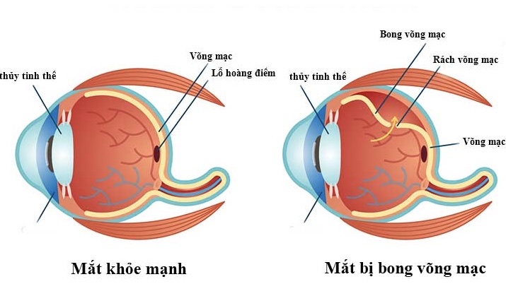 dot-quy-mat-noi-am-anh-ve-mat-thi-luc 4