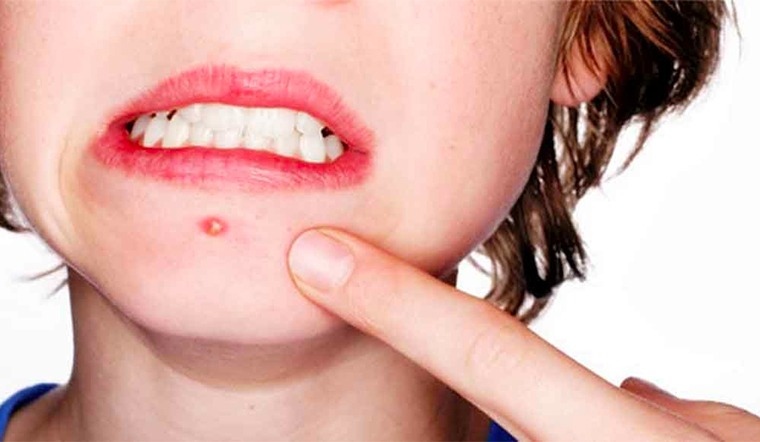 Dùng lá kinh giới chữa mụn nhọt có hiệu quả không?