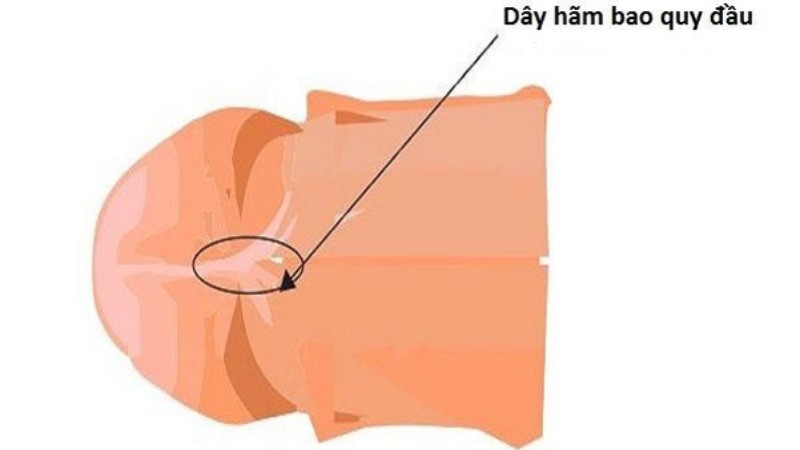 Đứt dây hãm bao quy đầu có sao không? 1