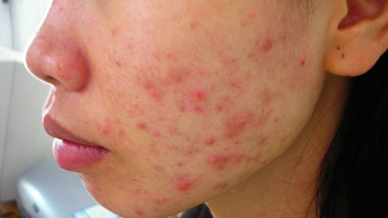 Filler Atiere xuất xứ từ đâu và có tốt không? 4