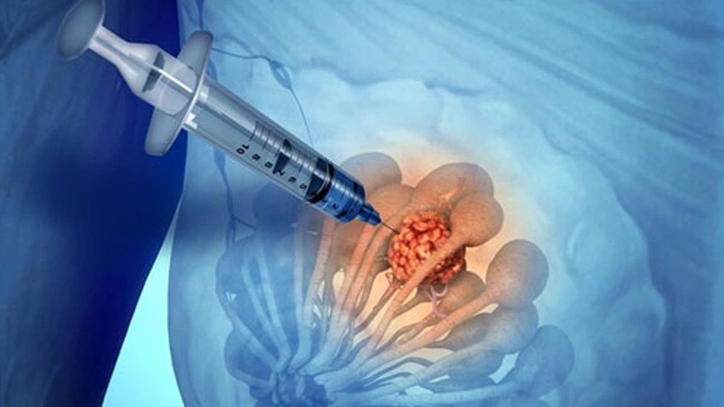 FNA - Chọc hút kim nhỏ ở vú là gì? Khi nào cần thực hiện FNA ở vú? 1