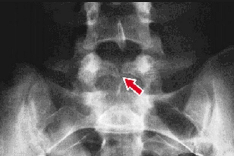 Gai đôi cột sống là gì? Gai đôi cột sống có nguy hiểm không? 2