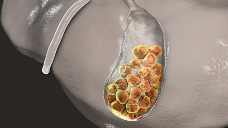 Gall bladder là gì và các bệnh lý thường gặp tại gall bladder 2