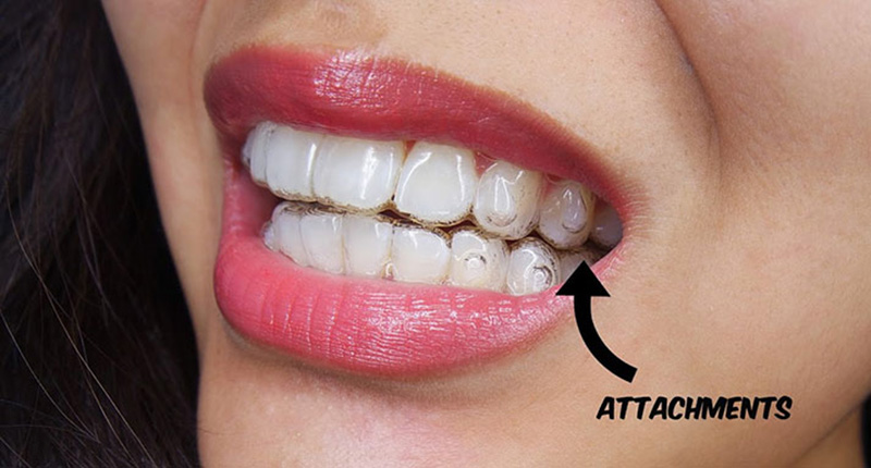 Gắn Attachment khi niềng răng Invisalign có tác dụng gì?