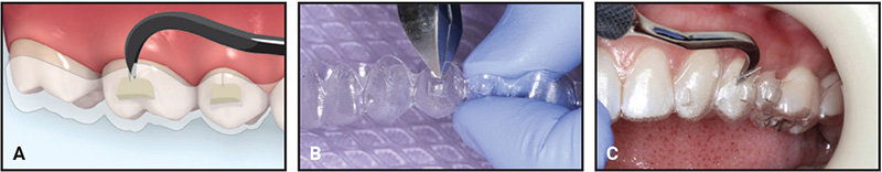 Gắn Attachment khi niềng răng Invisalign có tác dụng gì?