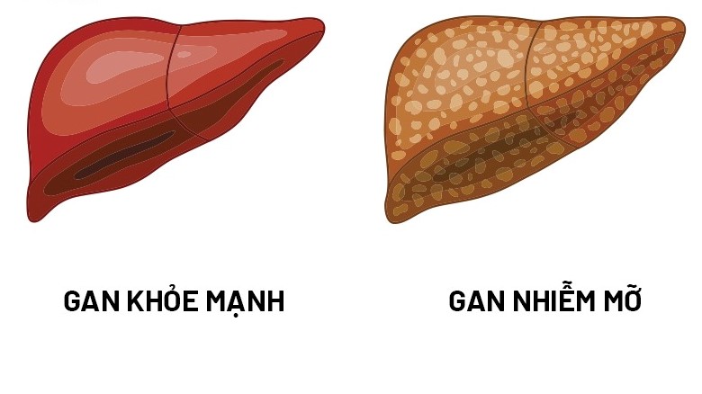 Gan nhiễm mỡ là bệnh gì? Bị gan nhiễm mỡ uống gì hết? 4