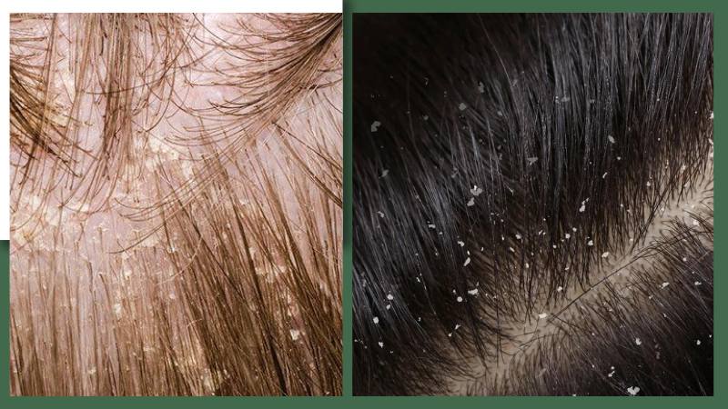 Gàu ướt: Nguyên nhân phát sinh và cách trị tận gốc 2