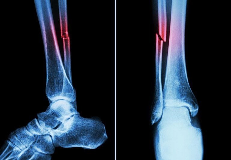 Gãy 1/3 dưới xương mác có nguy hiểm không? 4