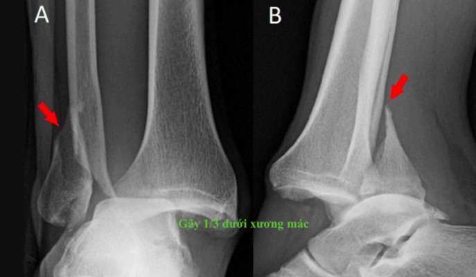 Gãy 1/3 dưới xương mác có nguy hiểm không? 2