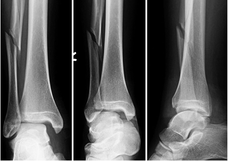 Gãy 1/3 dưới xương mác có nguy hiểm không? 3
