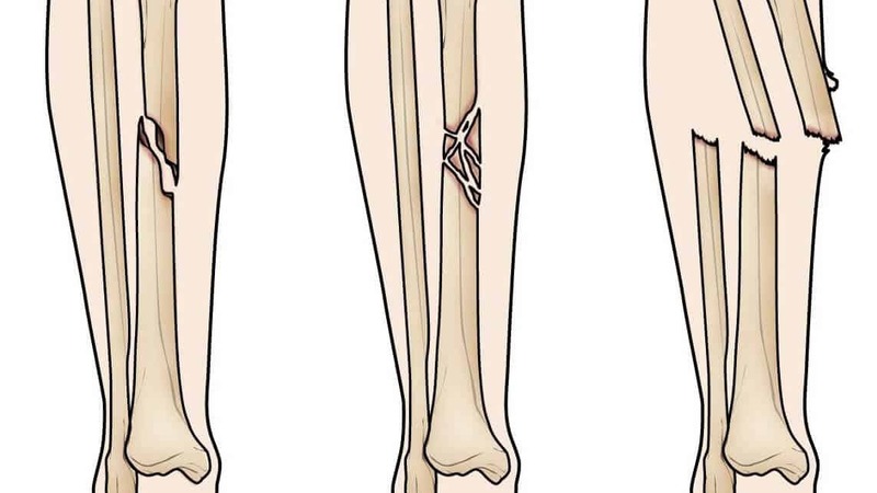Gãy 2 xương cẳng chân bao lâu thì lành? Bí quyết giúp xương nhanh liền 1