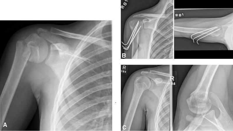 Gãy đầu trên xương cánh tay: Nguyên nhân, dấu hiệu và giải pháp 1