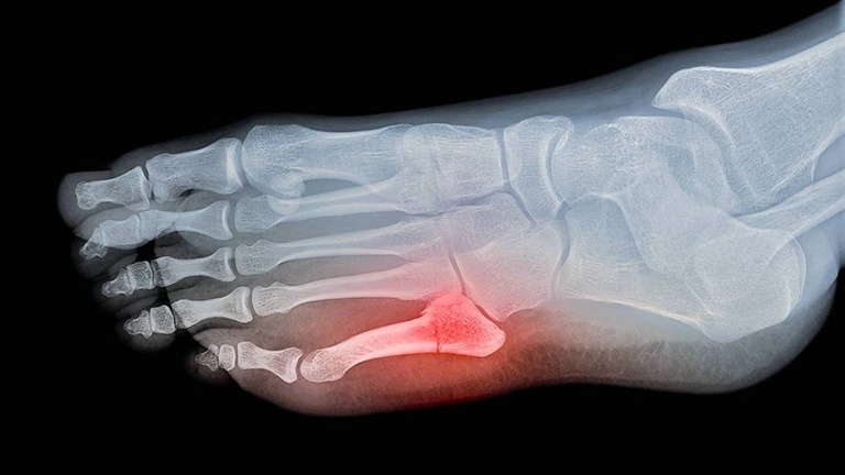 Gãy xương bàn chân số 5 bó bột bao lâu? 2