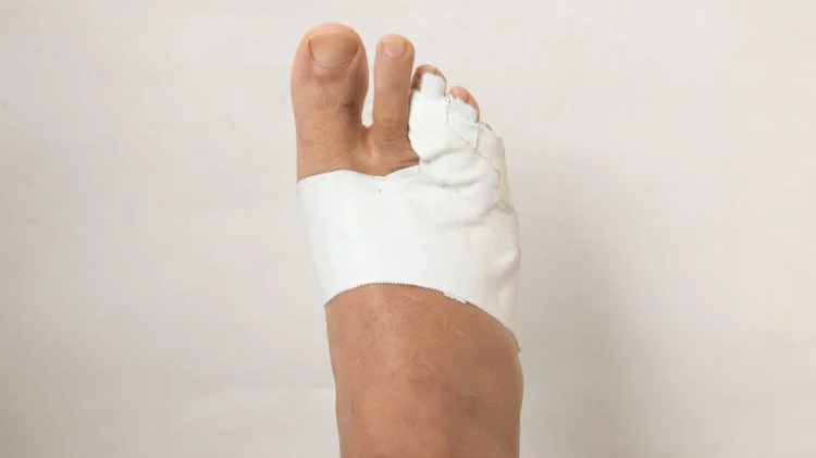 Gãy xương bàn chân số 5 bó bột bao lâu? 3