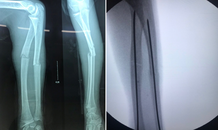 Cách sơ cứu nhanh chóng người bị gãy xương cẳng tay 1