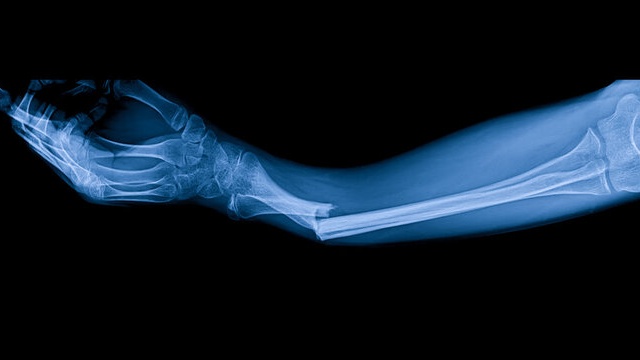 Gãy xương cẳng tay bao lâu thì lành? Cách điều trị chấn thương cẳng tay 1