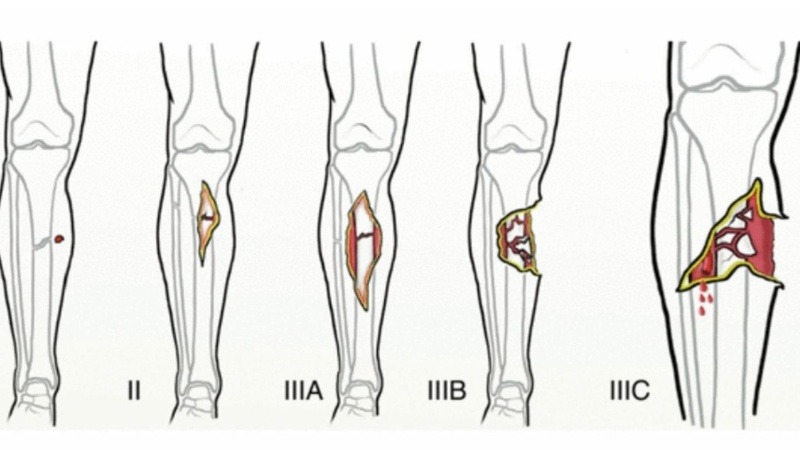 Gãy xương hở: Nguyên nhân, biến chứng và cách điều trị 1