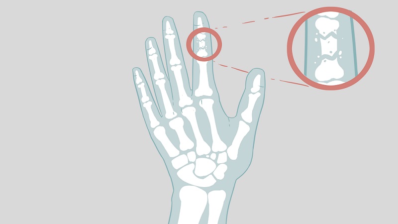 Gãy xương ngón tay: Nguyên nhân, triệu chứng và điều trị 1