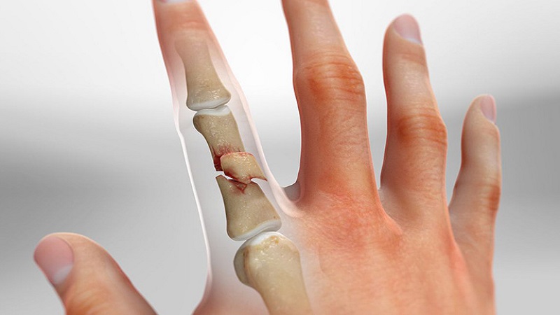 Gãy xương ngón tay: Nguyên nhân, triệu chứng và điều trị 2