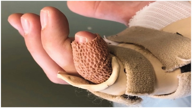 Gãy xương ngón tay: Nguyên nhân, triệu chứng và điều trị 5