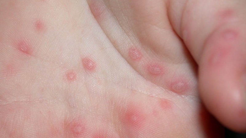 Ghẻ nước ở trẻ là gì? Có để lại biến chứng không? 1