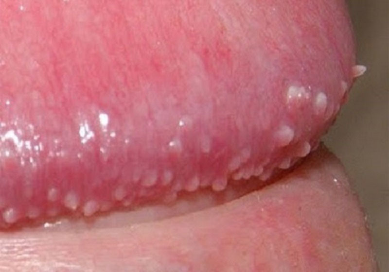 Giải đáp: Bao quy đầu nổi mẩn đỏ không ngứa là bị gì? Có nguy hiểm không? 1