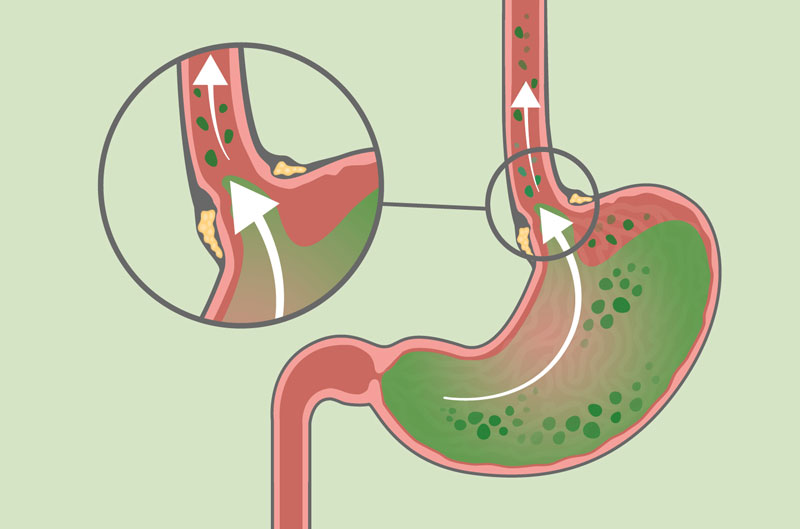 Giải đáp: Bị trào ngược dạ dày có nên uống ngũ cốc? 6