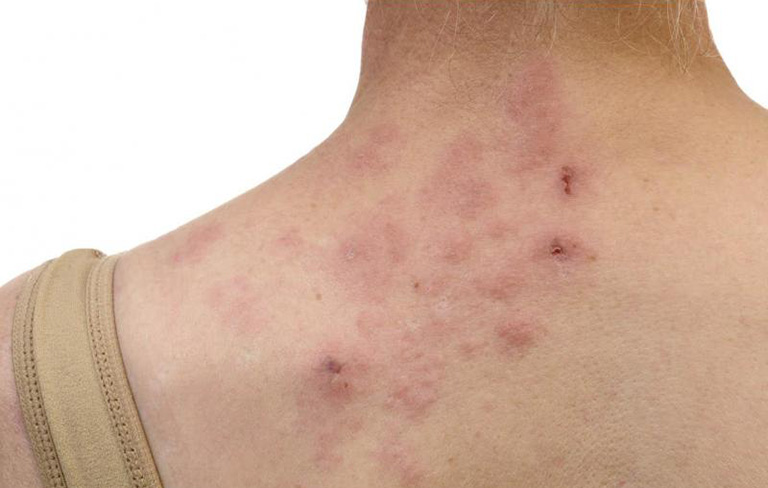 Giải đáp: Bị zona thần kinh bao lâu thì khỏi? 3