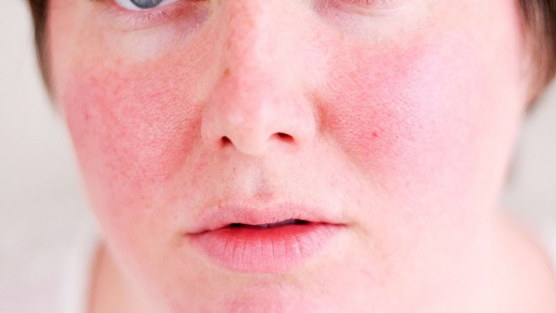 Peel Glycolic Acid không đúng cách có thể gây bỏng rát da
