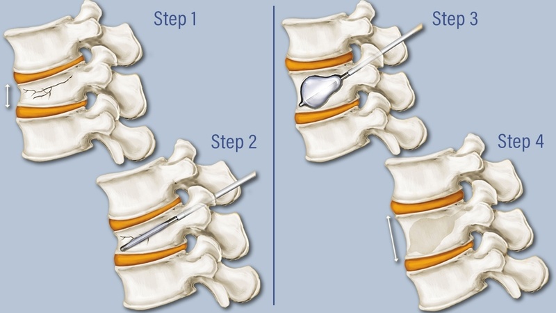 Bơm xi măng là phương pháp điều trị gãy đốt sống lưng L1