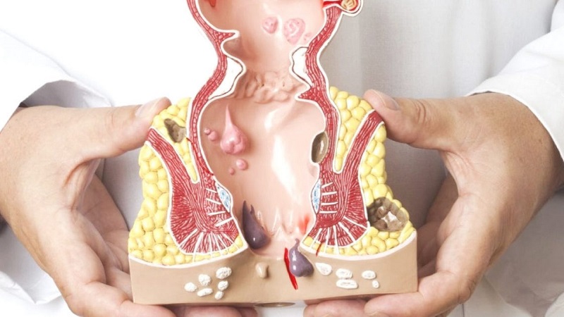 Giải đáp: Lòi dom là gì? Bệnh lòi dom có tự khỏi không? 2