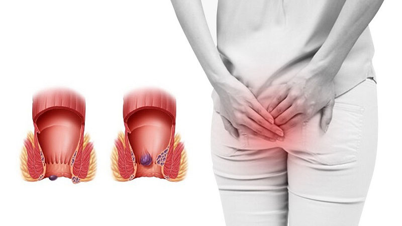 Giải đáp: Lòi dom là gì? Bệnh lòi dom có tự khỏi không? 1