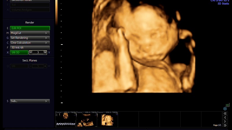 Giải đáp: Mẹ bầu 1 tháng siêu âm 1 lần có sao không? 3