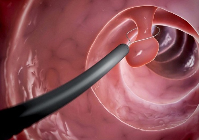 Giải đáp: Sinh thiết tế bào ung thư có nguy hiểm không? 2