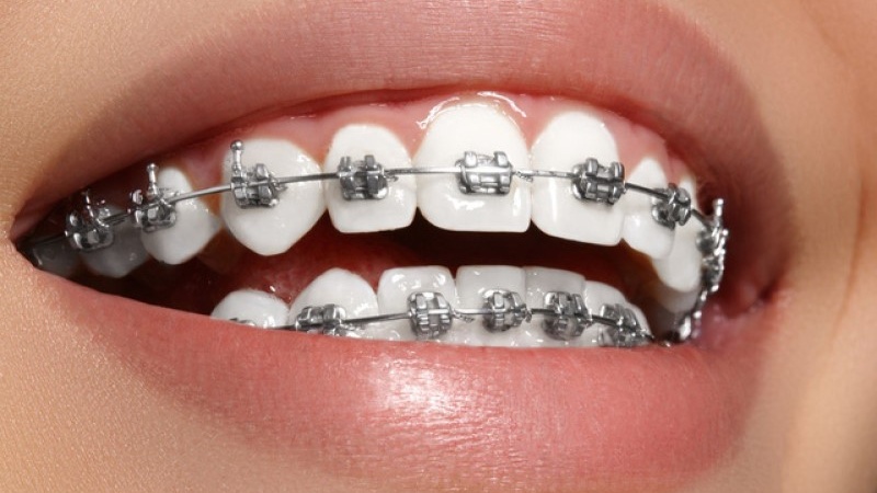 Giải đáp răng bị nghiêng có niềng được không? 3