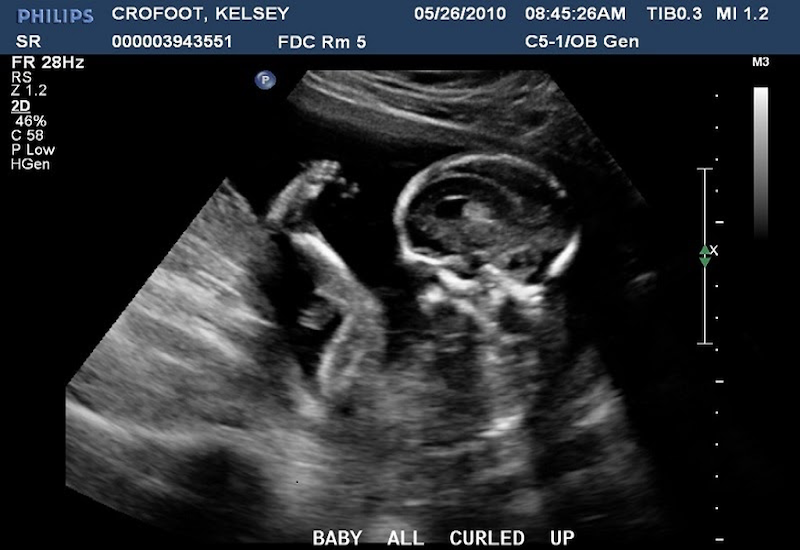 Giải đáp: Siêu âm 2D có chính xác không? 5