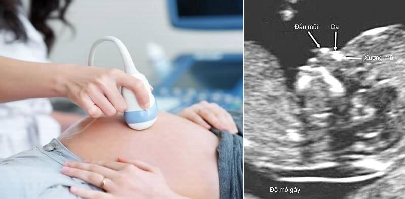 Giải đáp sức khỏe sinh sản: Không đo độ mờ da gáy có sao không? 3