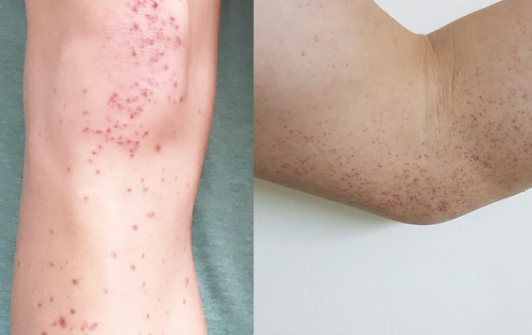 giai-dap-thac-mac-viem-mao-mach-di-ung-bao-lau-thi-khoi 1.jpg