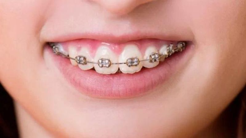 Giải đáp: Tình trạng răng hô nặng có hết được không? 4