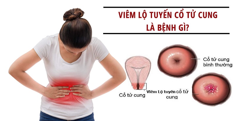 Giải đáp: Viêm lộ tuyến cổ tử cung 2cm nặng hay nhẹ? 3