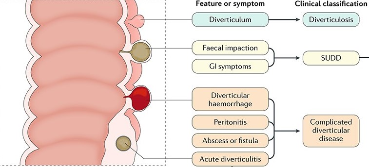 Giải đáp: Viêm túi thừa đại tràng kiêng ăn gì? 3